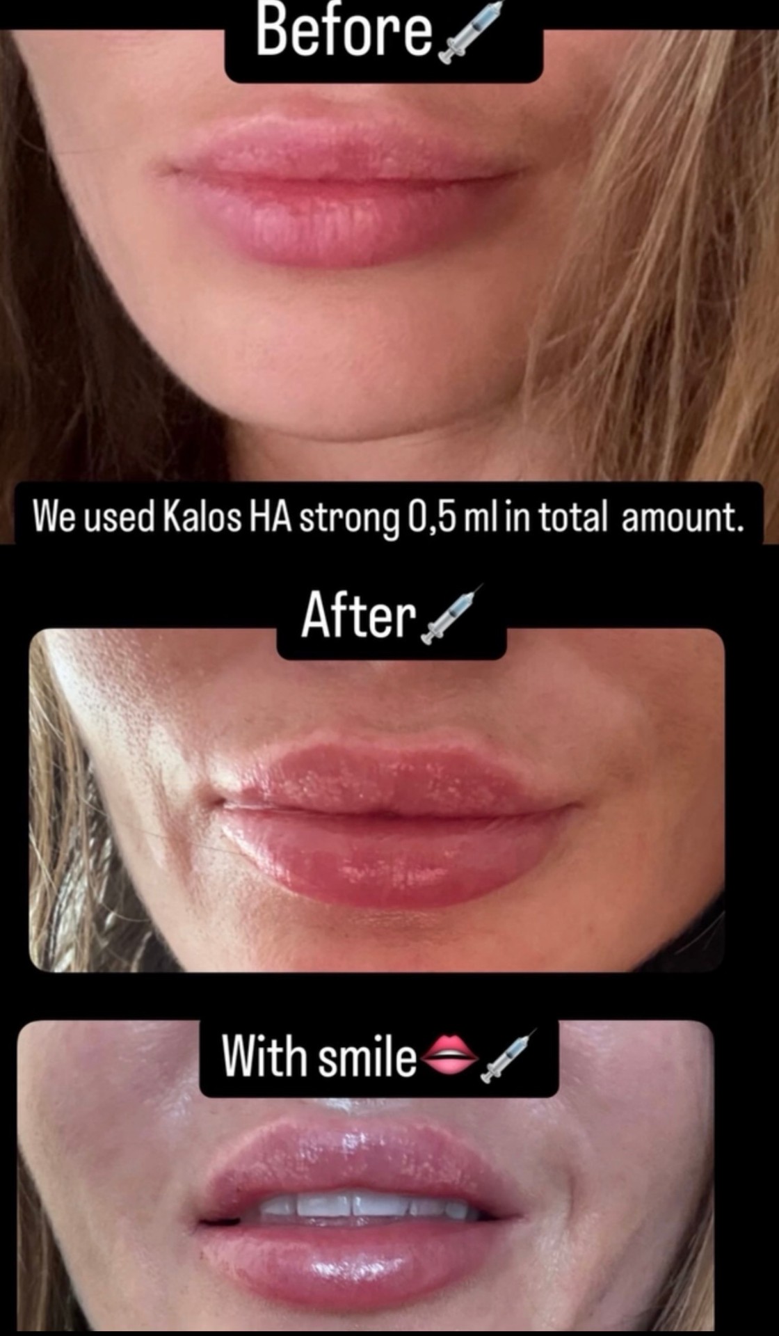 Lip treatment result — Kalos HA