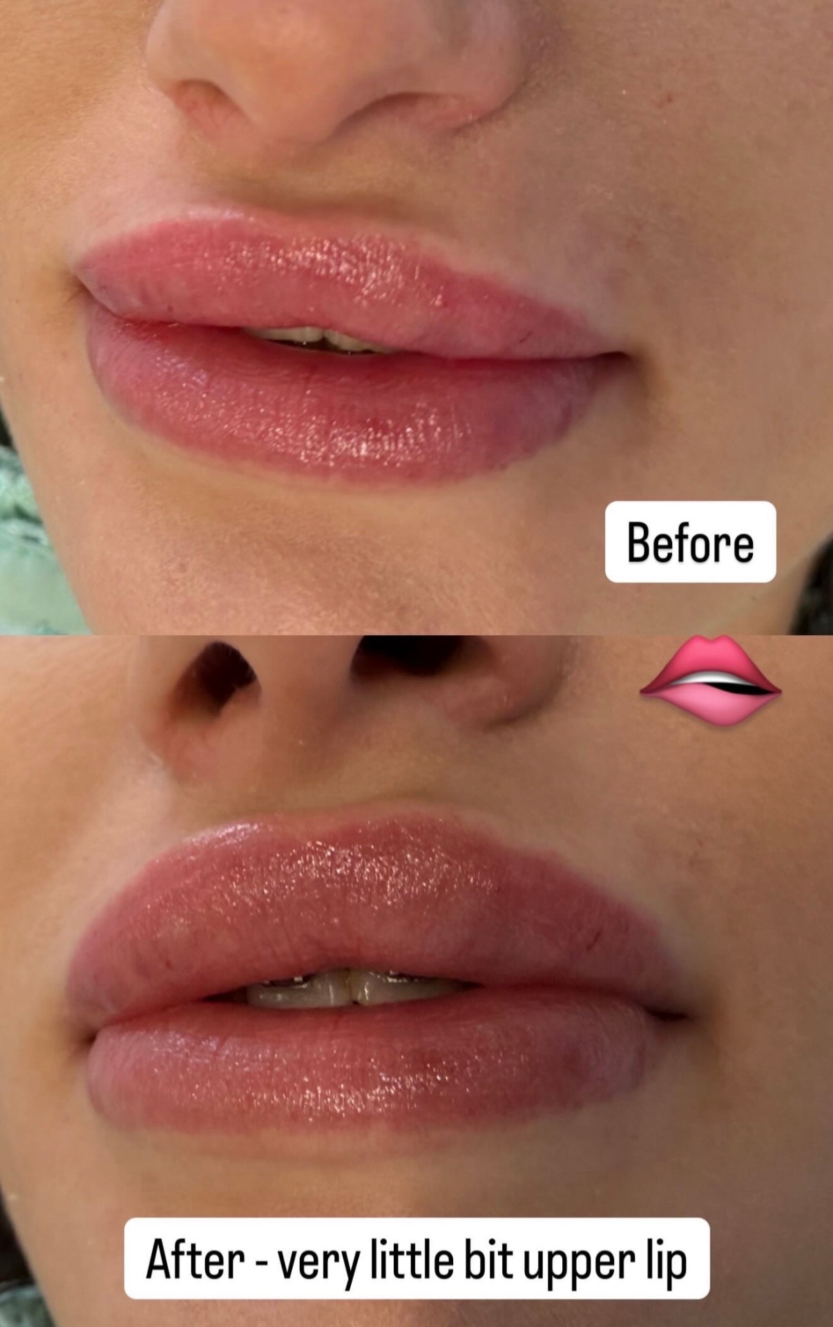 Upper lip correction result