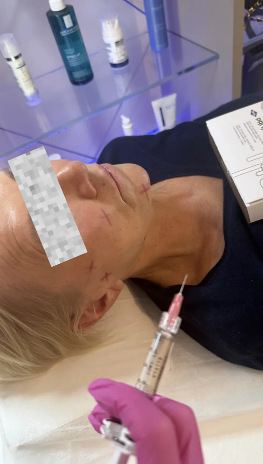 Aplikace skinboosteru do tváře a nasolabiální rýhy